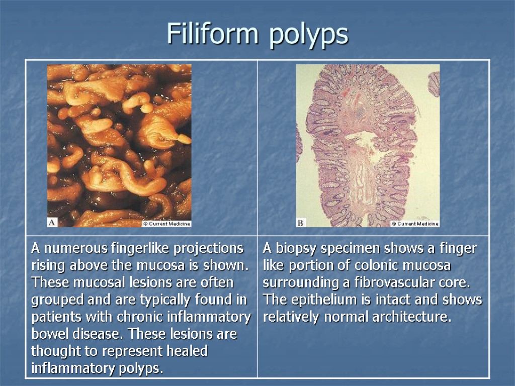 Filiform polyps